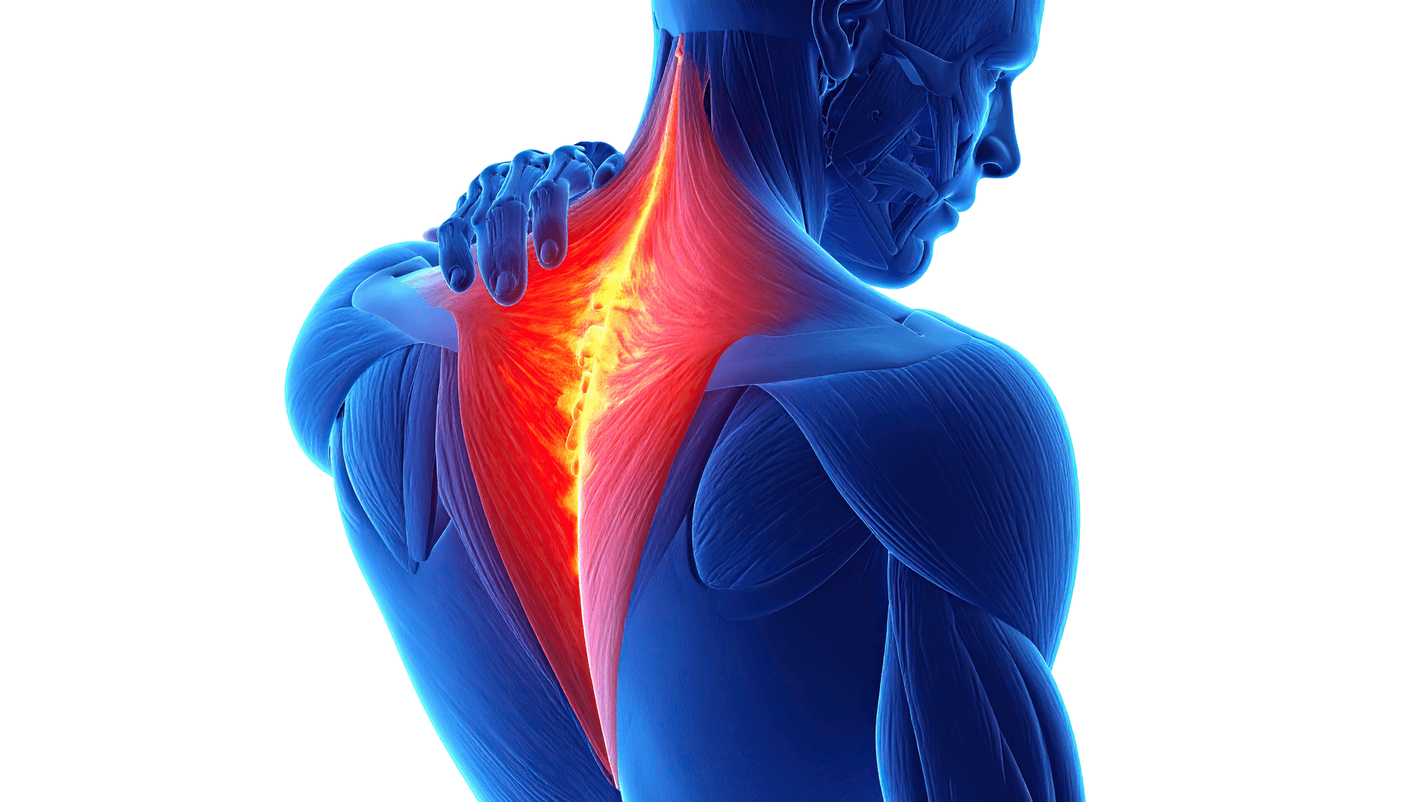 Illustrasjon av ryggmuskler og områder som ofte rammes av ryggsmerter