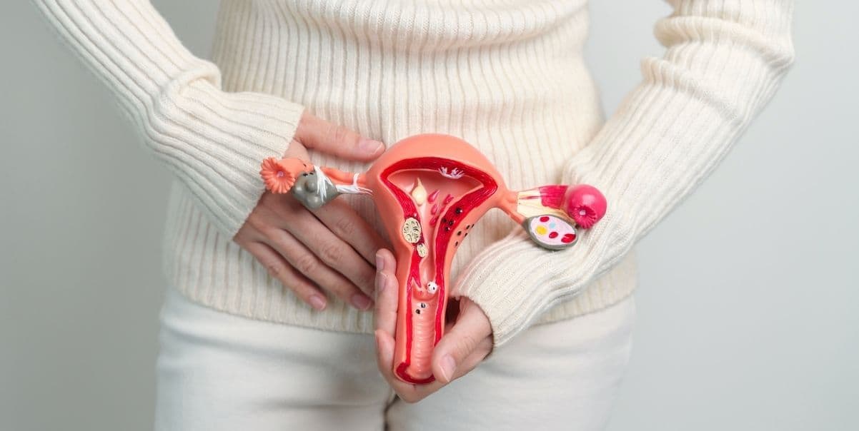 An illustration showing endometriosis tissue growing outside the uterus.