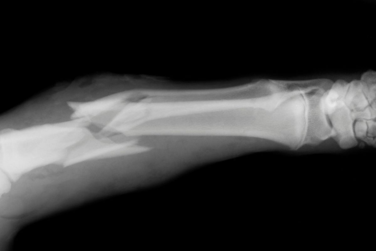 an x-ray of a broken bone can be seen against a dark background